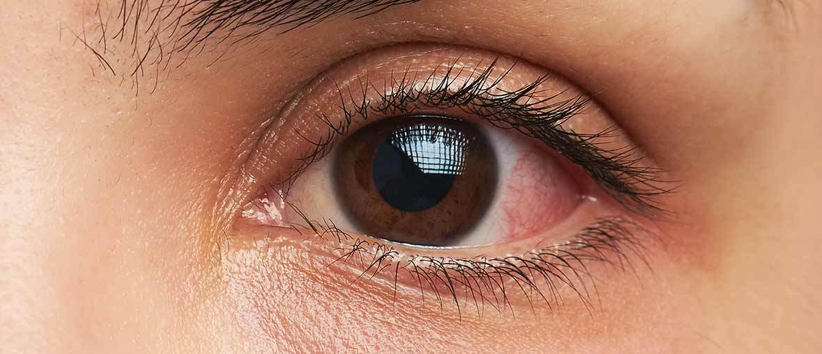 Øjenbetændelse - Hvordan det? Profil Optik